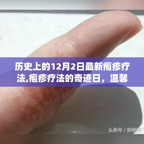 疱疹疗法的奇迹日，友情与爱在历史上的温馨故事